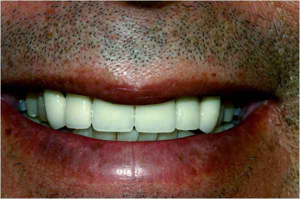 Dental Crowns After Dental Crowns After