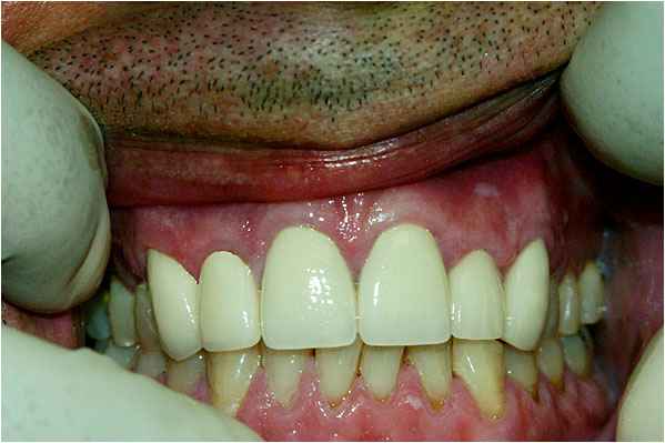 Dental Crowns After Dental Crowns After