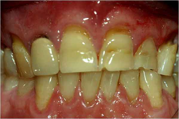 Dental Crowns Before Dental Crowns Before