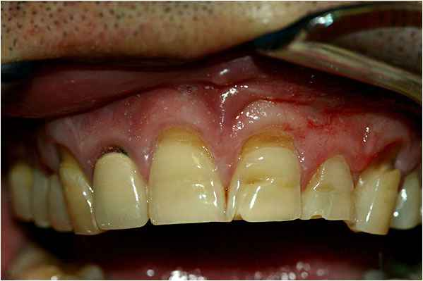 Dental Crowns Before Dental Crowns Before