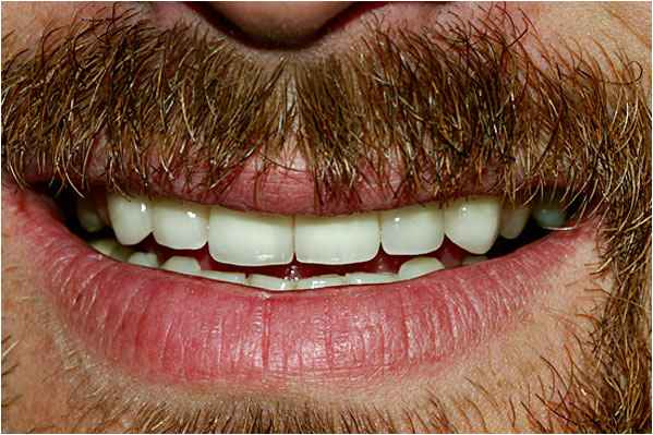 Dental Crowns After Dental Crowns After