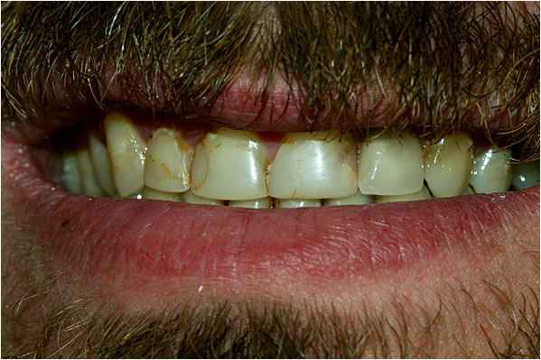 Dental Crowns Before Dental Crowns Before
