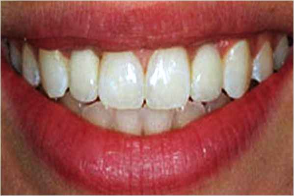 Dental Implants After Dental Implants After