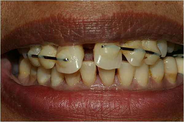 Dental Implants Before Dental Implants Before