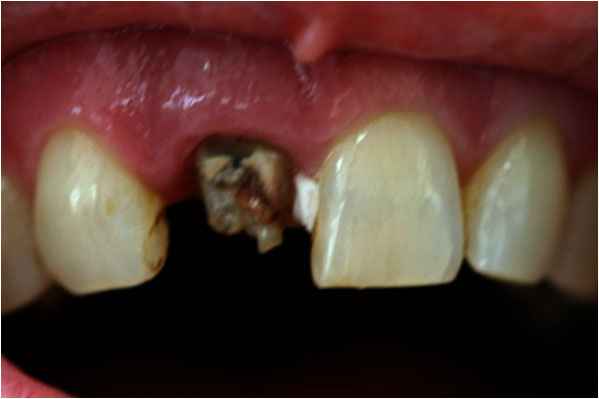 Dental Implants Before Dental Implants Before