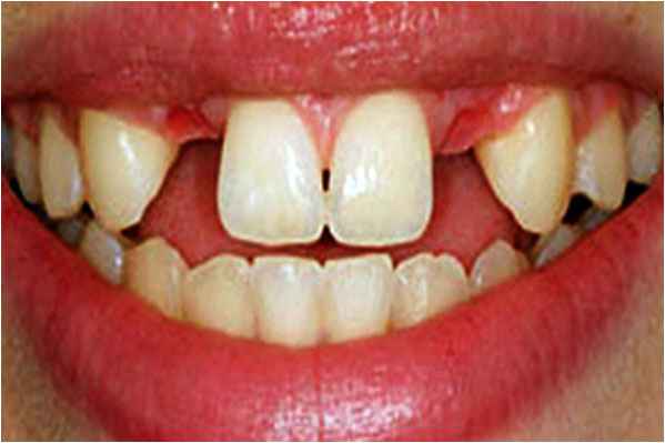 Dental Implants Before Dental Implants Before