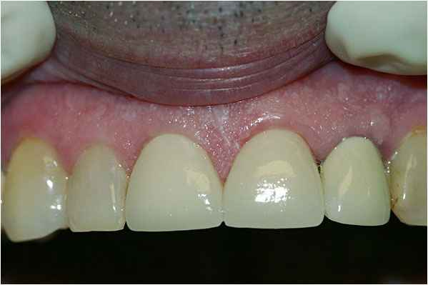 Dental Crowns After Dental Crowns After