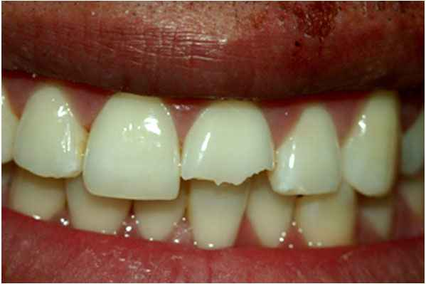 Dental Crowns Before Dental Crowns Before
