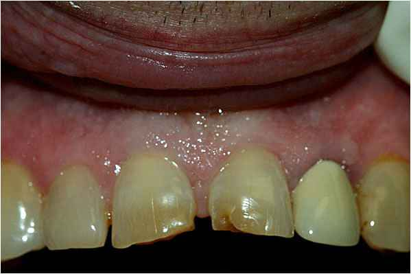 Dental Crowns Before Dental Crowns Before
