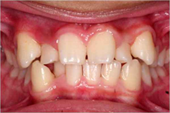 Orthodontics Before Orthodontics Before