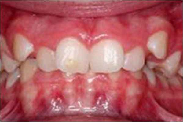Orthodontics Before Orthodontics Before