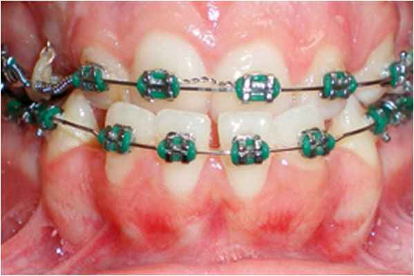 Orthodontics Before Orthodontics Before