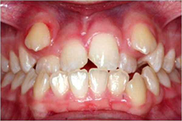 Orthodontics Before Orthodontics Before