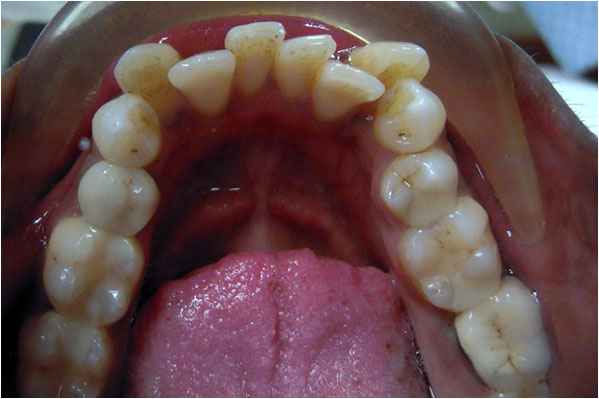 Orthodontics Before Orthodontics Before