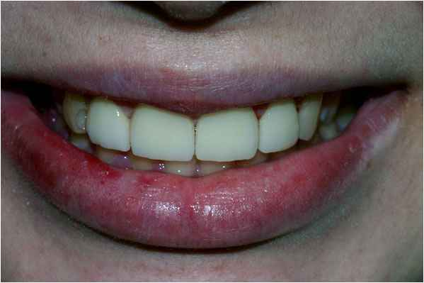 Veneers After Veneers After