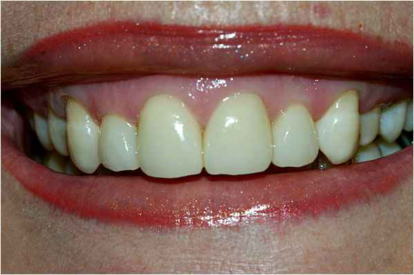 Veneers After Veneers After