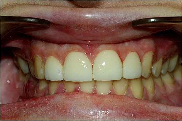 Veneers After Veneers After