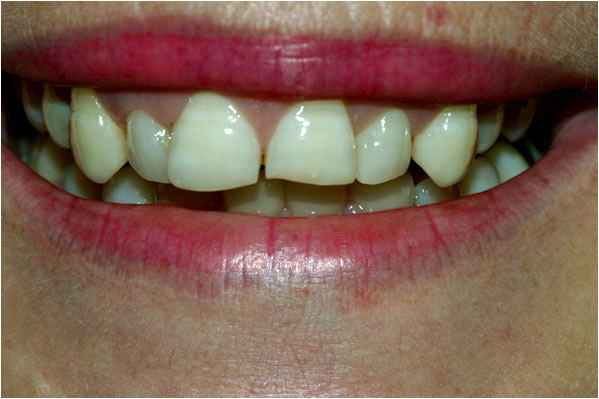 Veneers Before Veneers Before