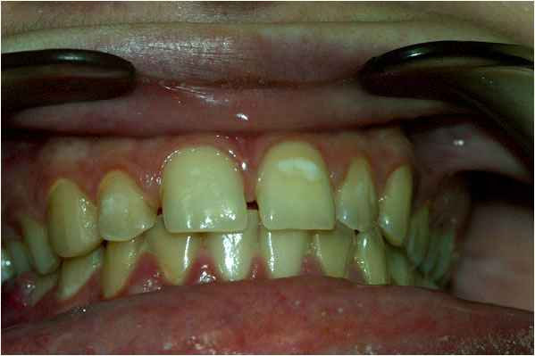 Veneers Before Veneers Before